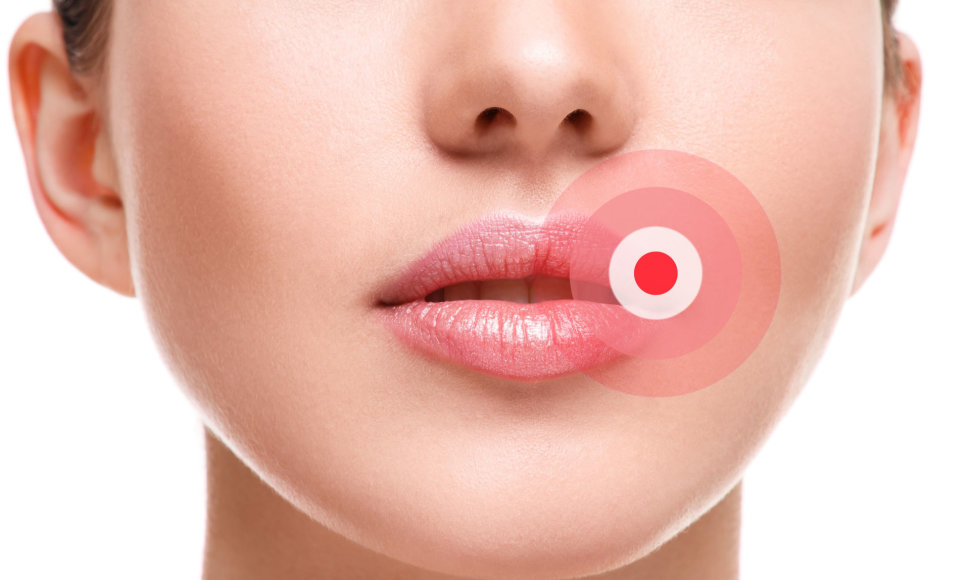 Herpes ir Kosmetinės Procedūros: Ką turite žinoti?